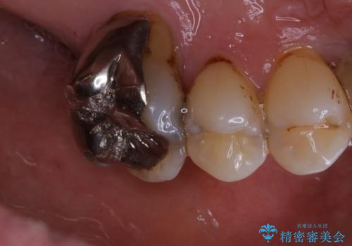 全体的な治療の開始前に着色取りの治療前