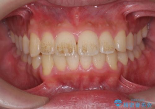 歯の表面に付着したステインをPMTCで除去。の治療前