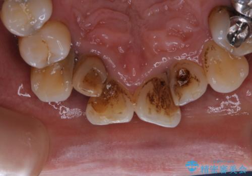 全体的な治療の開始前に着色取り