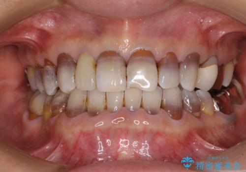 下の歯が前に出てしまう咬み合わせを治したい　インビザラインによる矯正治療