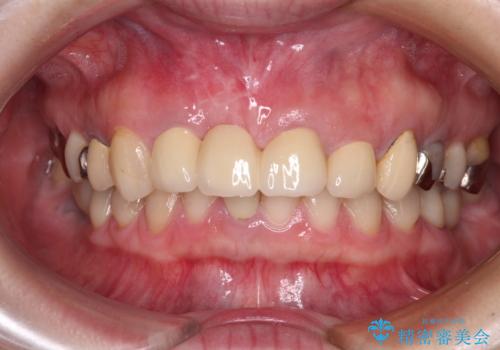 鼻の下を押すと痛い 抜歯を避けてきた歯を抜歯して自然な口元にの治療後