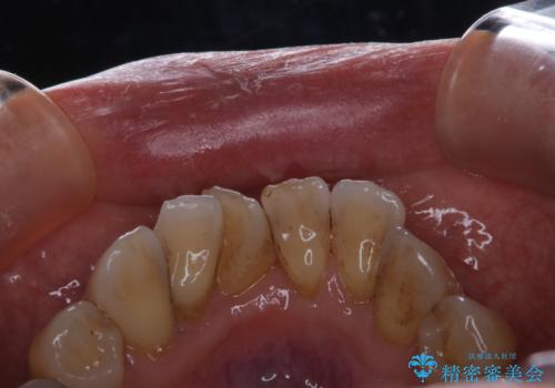 全体的な治療の開始前に着色取りの治療前