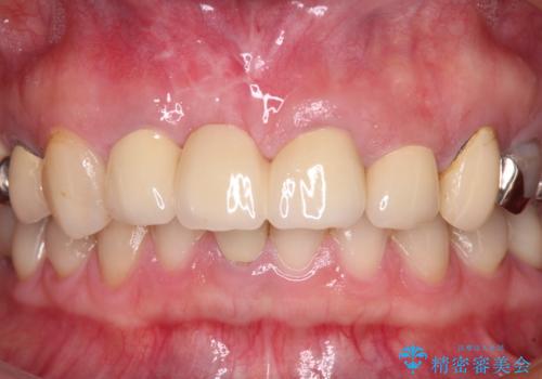 鼻の下を押すと痛い 抜歯を避けてきた歯を抜歯して自然な口元にの治療後