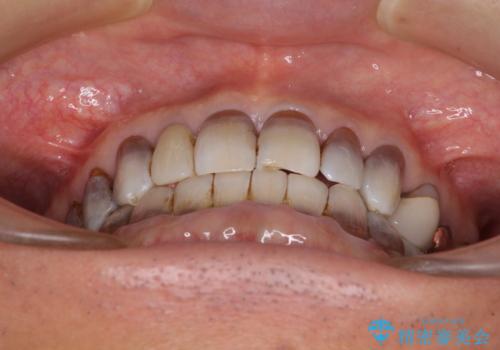 下の歯が前に出てしまう咬み合わせを治したい インビザラインによる矯正治療の治療後