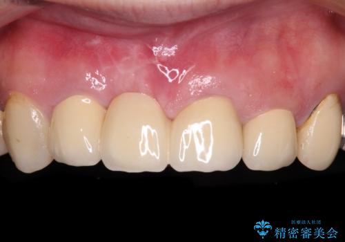 鼻の下を押すと痛い 抜歯を避けてきた歯を抜歯して自然な口元にの症例 治療後