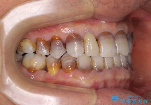 下の歯が前に出てしまう咬み合わせを治したい インビザラインによる矯正治療の治療後