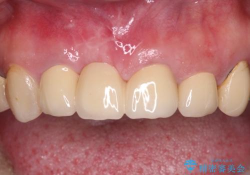 鼻の下を押すと痛い 抜歯を避けてきた歯を抜歯して自然な口元にの治療後
