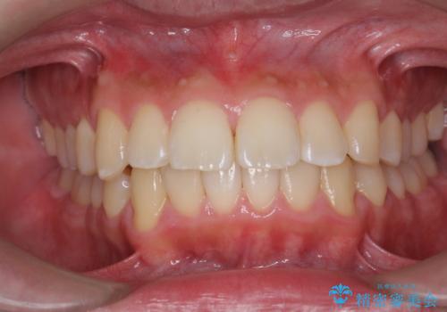 歯の表面に付着したステインをPMTCで除去。の治療後
