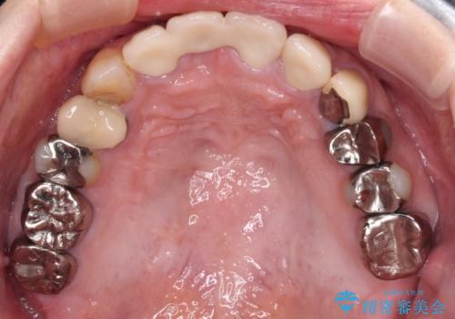 鼻の下を押すと痛い 抜歯を避けてきた歯を抜歯して自然な口元にの治療後