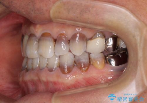 下の歯が前に出てしまう咬み合わせを治したい インビザラインによる矯正治療の治療後