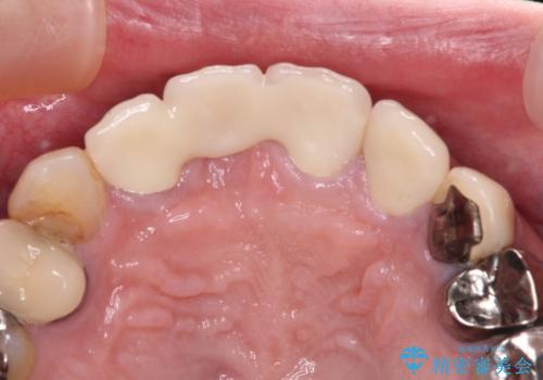 鼻の下を押すと痛い 抜歯を避けてきた歯を抜歯して自然な口元にの治療後