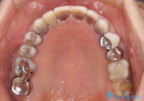 下の歯が前に出てしまう咬み合わせを治したい インビザラインによる矯正治療の治療後