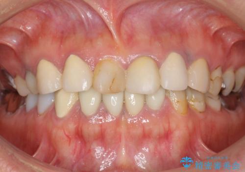 被せ物を入れたばかりの歯が痛む 40代女性の治療前