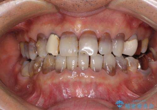 下の歯が前に出てしまう咬み合わせを治したい　インビザラインによる矯正治療の治療中