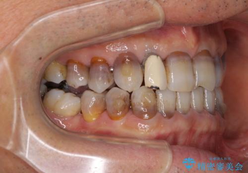 下の歯が前に出てしまう咬み合わせを治したい インビザラインによる矯正治療の治療中