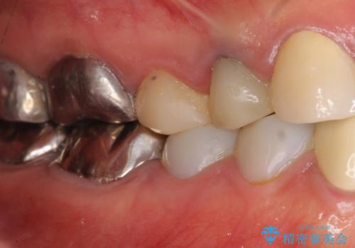 被せ物を入れたばかりの歯が痛む 40代女性の治療前