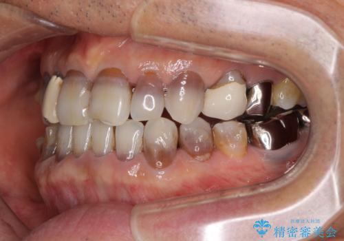 下の歯が前に出てしまう咬み合わせを治したい インビザラインによる矯正治療の治療中