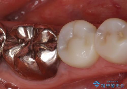 被せ物を入れたばかりの歯が痛む 40代女性の症例 治療前