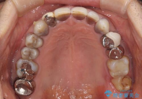 下の歯が前に出てしまう咬み合わせを治したい インビザラインによる矯正治療の治療中