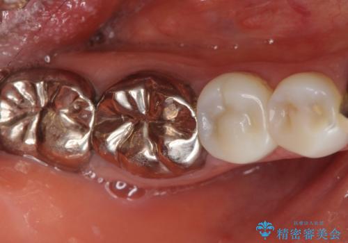 被せ物を入れたばかりの歯が痛む 40代女性の治療前
