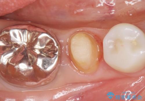 被せ物を入れたばかりの歯が痛む 40代女性の治療中