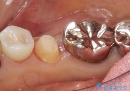 被せ物を入れたばかりの歯が痛む 40代女性の治療中