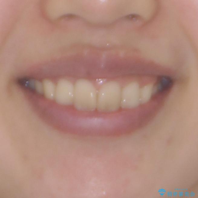 就職前にきれいな歯並びにしたい 大学生のインビザライン矯正の治療後(顔貌)
