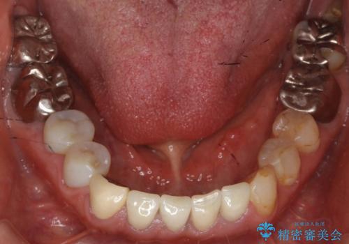 被せ物を入れたばかりの歯が痛む 40代女性の治療前