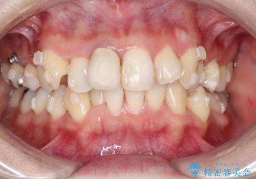 上下のガタガタのマウスピースによる非抜歯矯正の治療中