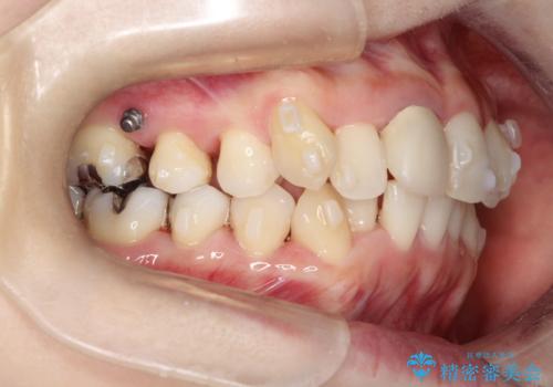 上下のガタガタのマウスピースによる非抜歯矯正の治療中