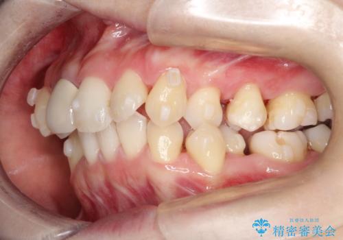 上下のガタガタのマウスピースによる非抜歯矯正の治療中