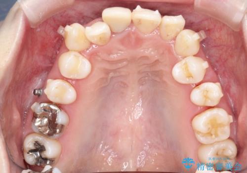 上下のガタガタのマウスピースによる非抜歯矯正の治療中