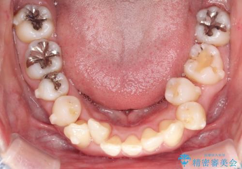 上下のガタガタのマウスピースによる非抜歯矯正の治療中