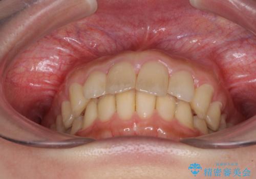 就職前にきれいな歯並びにしたい 大学生のインビザライン矯正の治療後