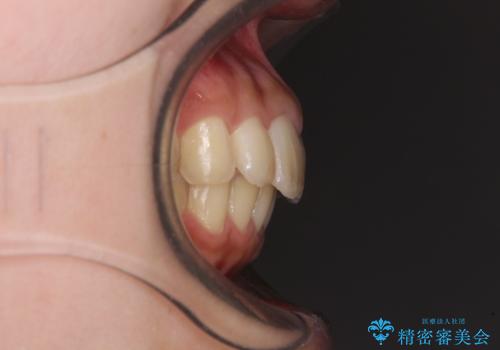 就職前にきれいな歯並びにしたい 大学生のインビザライン矯正の治療後