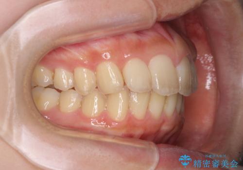 就職前にきれいな歯並びにしたい 大学生のインビザライン矯正の治療後