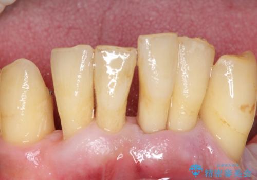 他院で抜歯と言われた歯　歯も神経も残したい　50代男性の症例 治療前