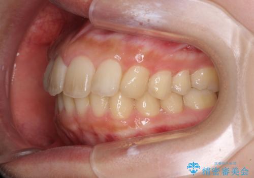 就職前にきれいな歯並びにしたい 大学生のインビザライン矯正の治療後