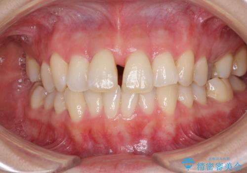 急速拡大装置で奥歯の咬み合わせを改善 インビザラインによる矯正治療の治療中