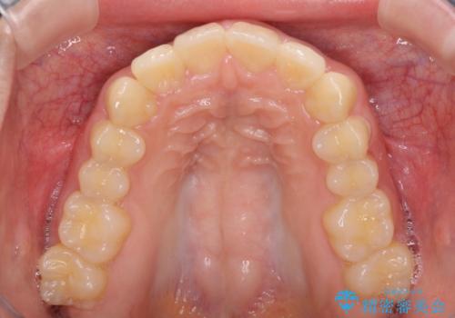 就職前にきれいな歯並びにしたい 大学生のインビザライン矯正の治療後