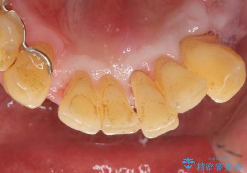 他院で抜歯と言われた歯 歯も神経も残したい 50代男性の治療前