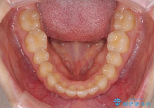 就職前にきれいな歯並びにしたい 大学生のインビザライン矯正の治療後