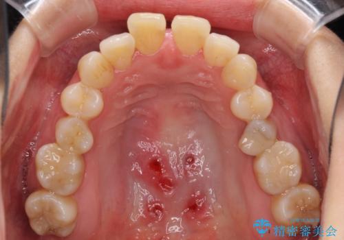 急速拡大装置で奥歯の咬み合わせを改善 インビザラインによる矯正治療の治療中