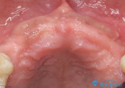 喫煙を再開してインプラント周囲炎に リカバリー治療 50代男性の治療前