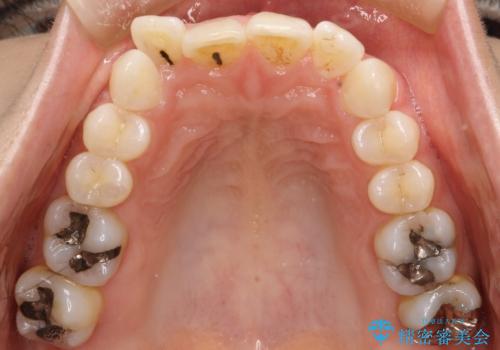 前歯のガタガタをインビザラインで矯正の治療前