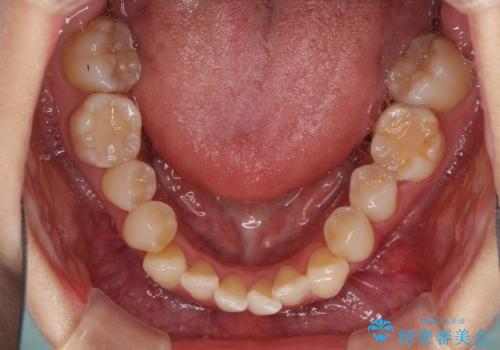 急速拡大装置で奥歯の咬み合わせを改善 インビザラインによる矯正治療の治療中
