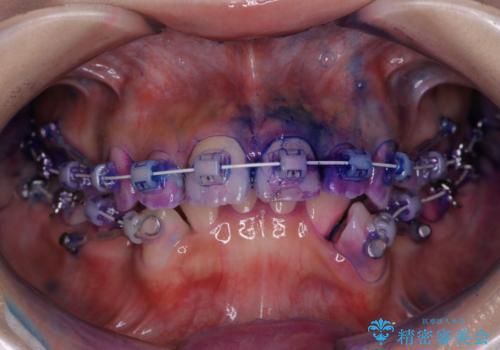 ワイヤー矯正中の歯のクリーニングの治療前