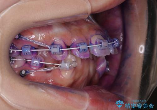 ワイヤー矯正中の歯のクリーニングの治療前