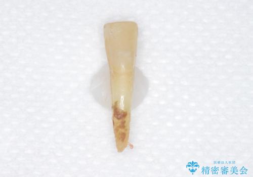 他院で抜歯と言われた歯 歯も神経も残したい 50代男性の治療前