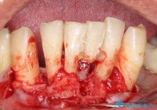 他院で抜歯と言われた歯 歯も神経も残したい 50代男性の治療中
